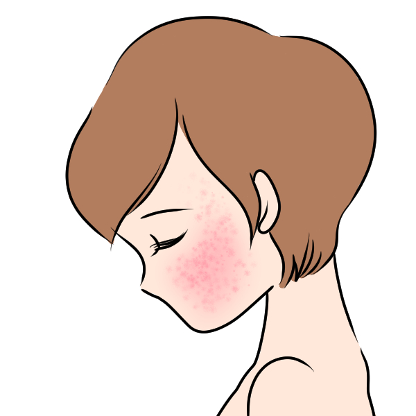 ニキビの悩み